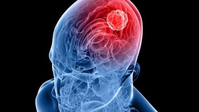 ما هي أسعار الأشعة التداخلية على المخ ؟