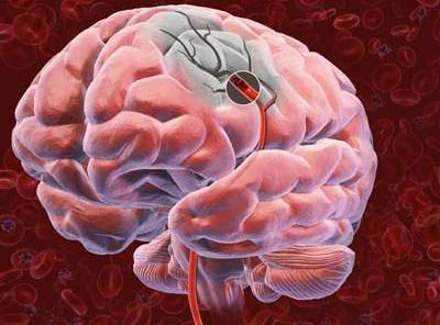 ما هي أسباب نقص التروية الدماغية وعلاجها بدون جراحة؟