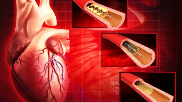 سعر القسطرة القلبية لعلاج أمراض القلب بدون مضاعفات