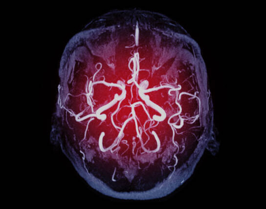 ما هي أشهر أعراض التهاب الأوعية الدموية في الدماغ