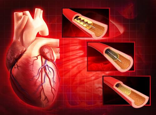 ما هي القسطرة القلبية والدعامات